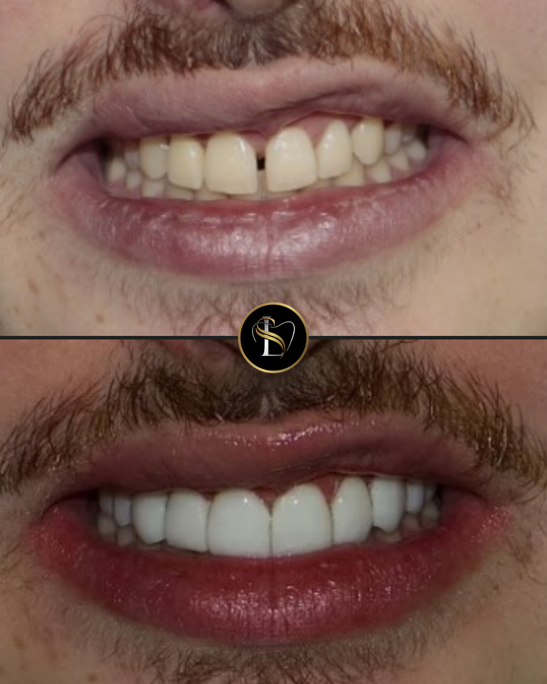 Caso clínico de facetas em resina em São Paulo SP - Antes e Depois