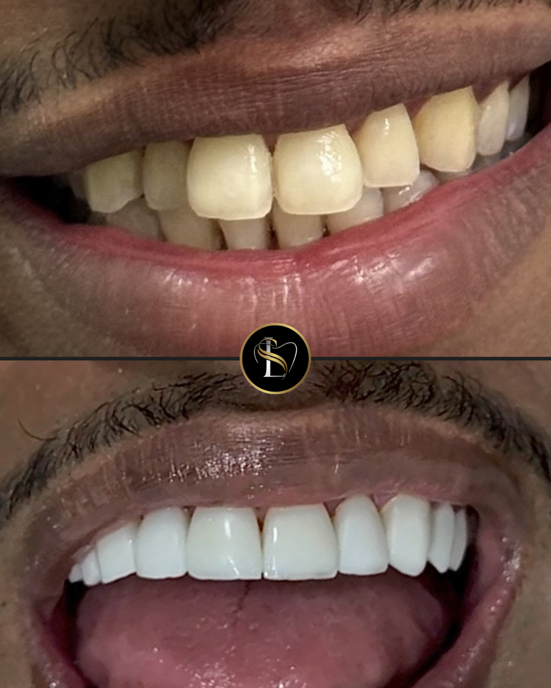 Caso clínico de facetas em resina em São Paulo SP - Antes e Depois