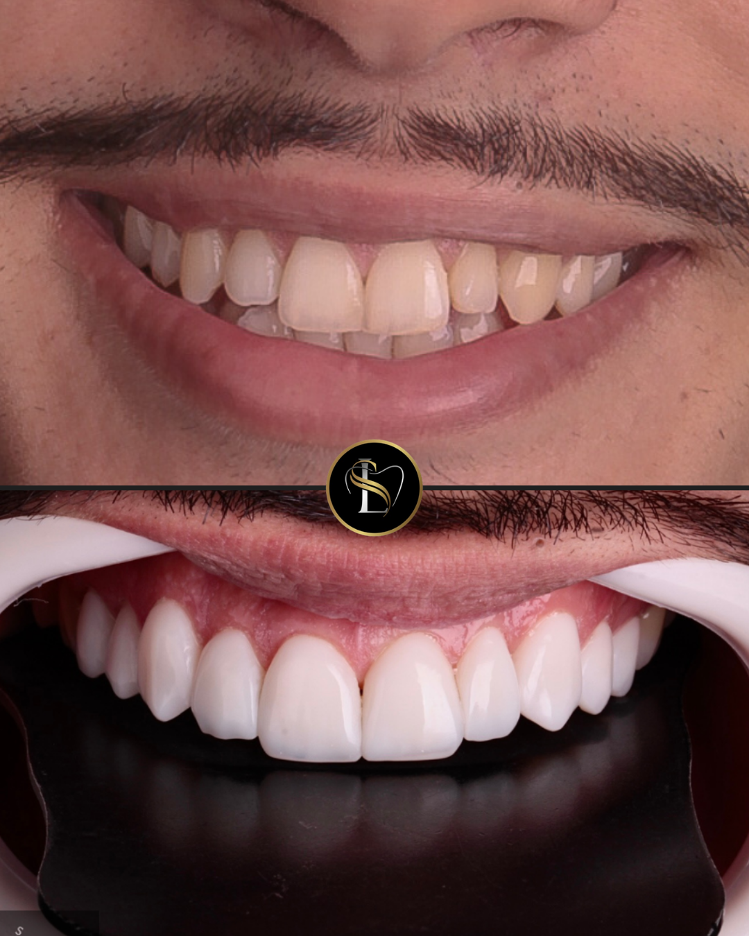 Caso clínico de facetas em resina em São Paulo SP - Antes e Depois