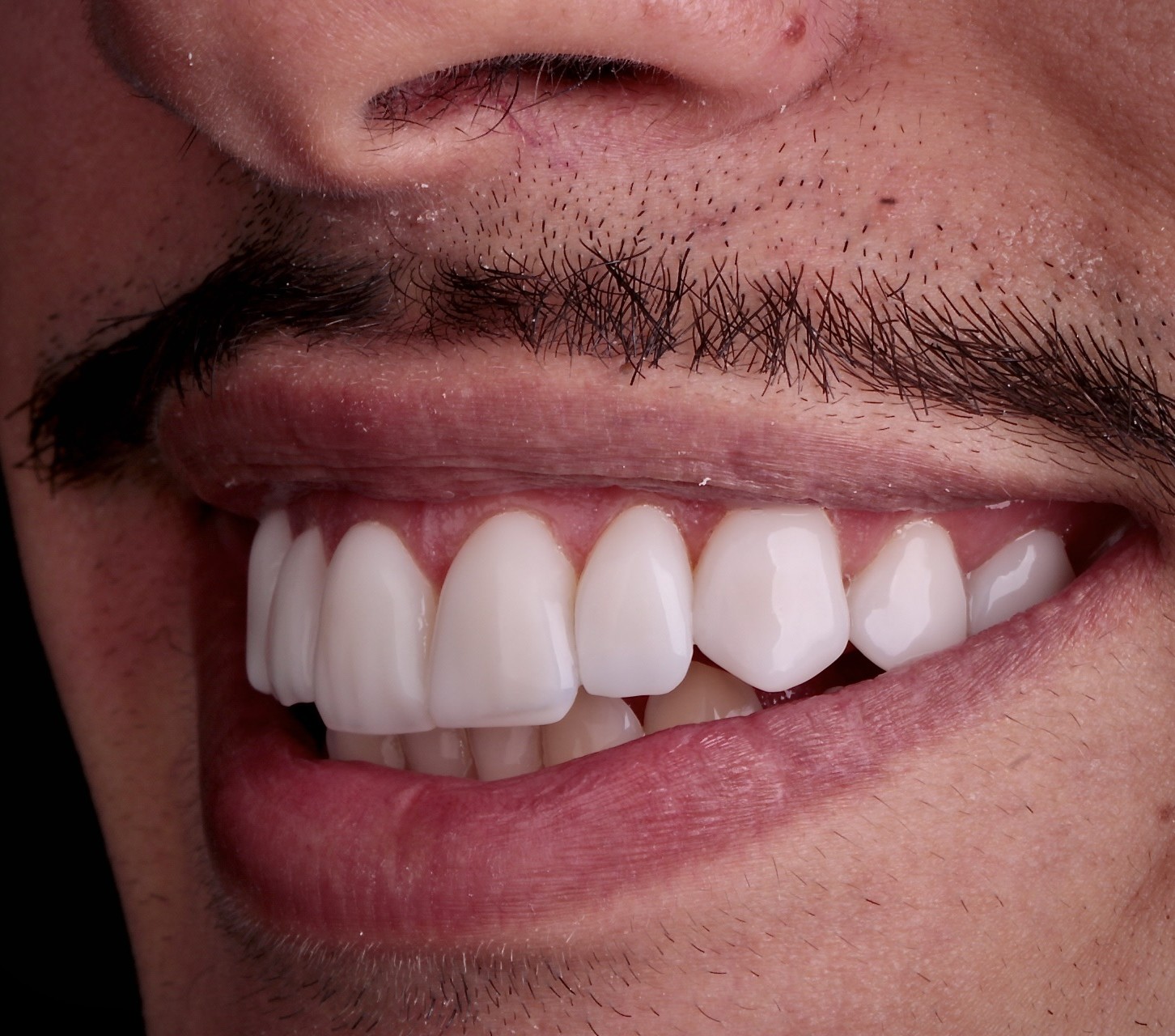 Protocolo de facetas em resina Dr. Lucas Sales São Paulo SP